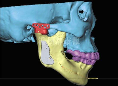 手术方案模拟图,红色和灰色部分为换上的人工关节.