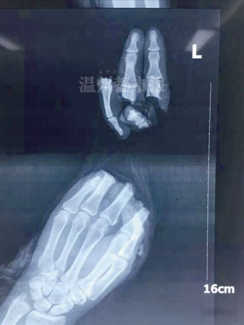 伤者左手的x光片.      院方供图