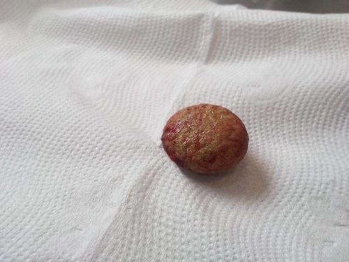 温州都市报4岁女童肚子里长了4颗结石小孩为何会患结石医生这样说